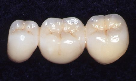 Tooth replacement-bridge