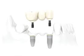 Implant bridge for tooth replacement