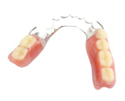 Removable partial dentures for tooth replacement