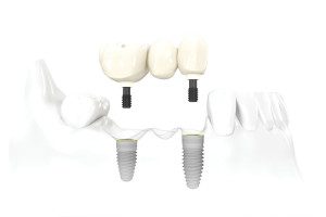 Dental implant bridge for tooth replacement