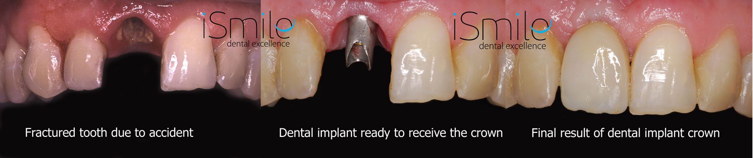 Replacement missing tooth implant