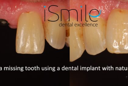 dental implant, natural, missing tooth